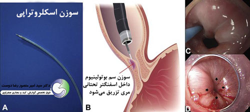 سم بوتولینیوم 