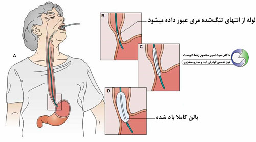 اتساع و ازوفاگومیوتومی برای درمان آشالازی