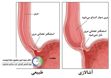 در آشالازی چه اتفاقی می‌افتد