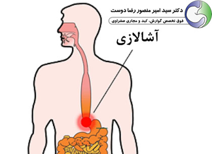 علل ایجادکننده آشالازی