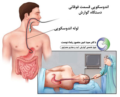 آندوسکوپی در تشخیص آشالازی