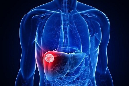 علائم بیماری هپاتیت سی در افراد مختلف