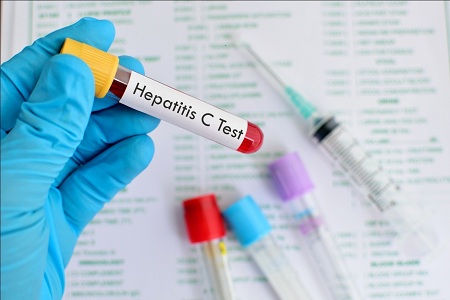 انواع روش های تشخیص بیماری هپاتیتC