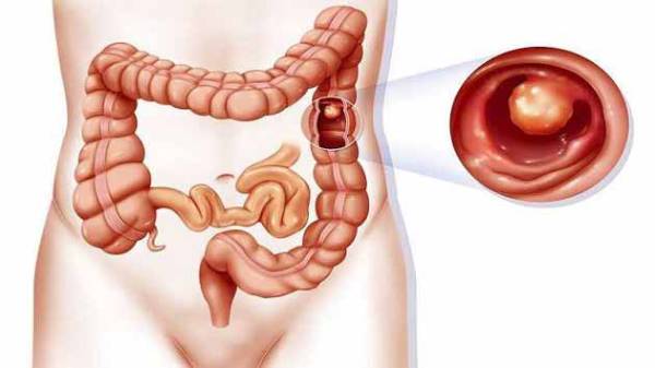 انواع مختلف بیماری_های التهابی روده شامل چه مواردی است؟