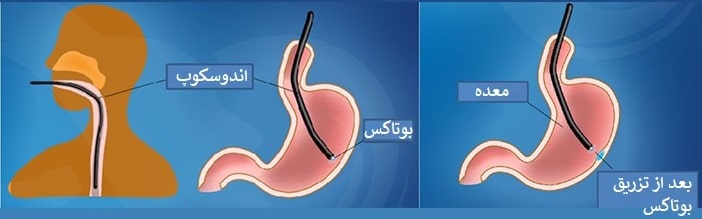 تزریق بوتاکس معده