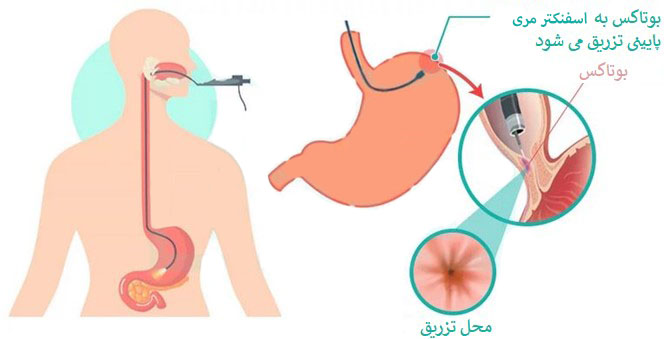 روند تزریق بوتاکس معده